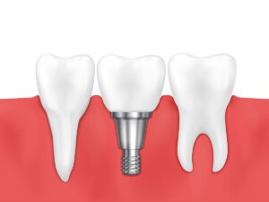dental implants dental implants