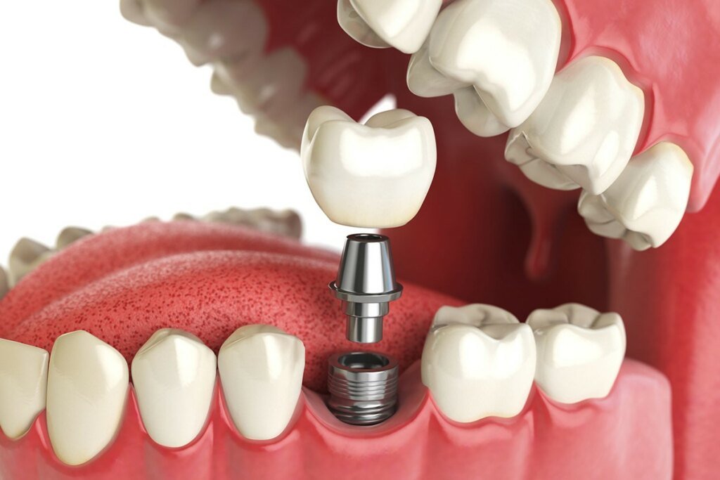 implant-banner-6 implant-banner-6