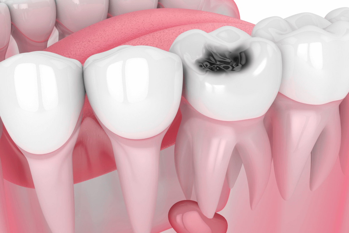 Cavities & Tooth Decay