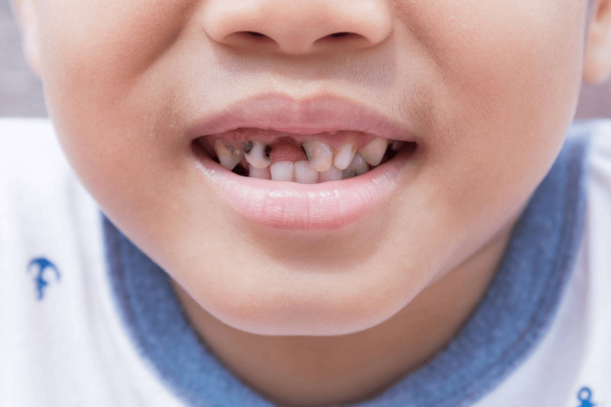 Cavities & Tooth Decay