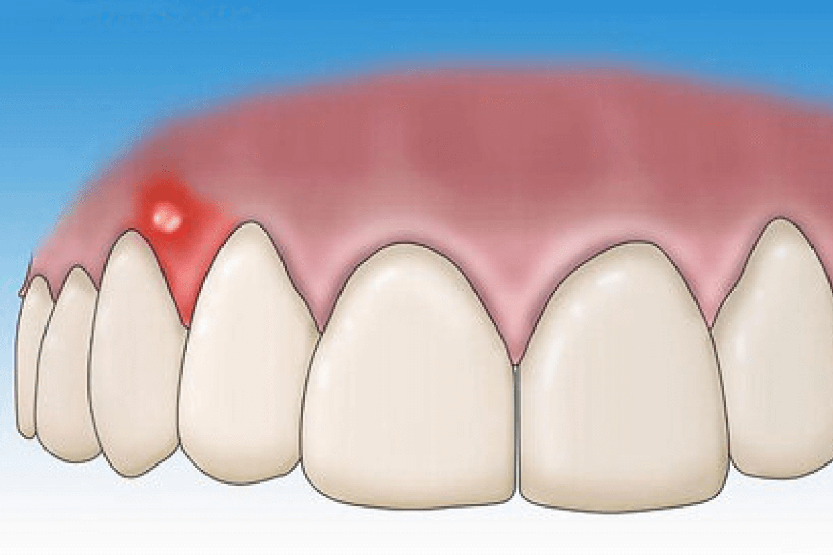 Cavities & Tooth Decay