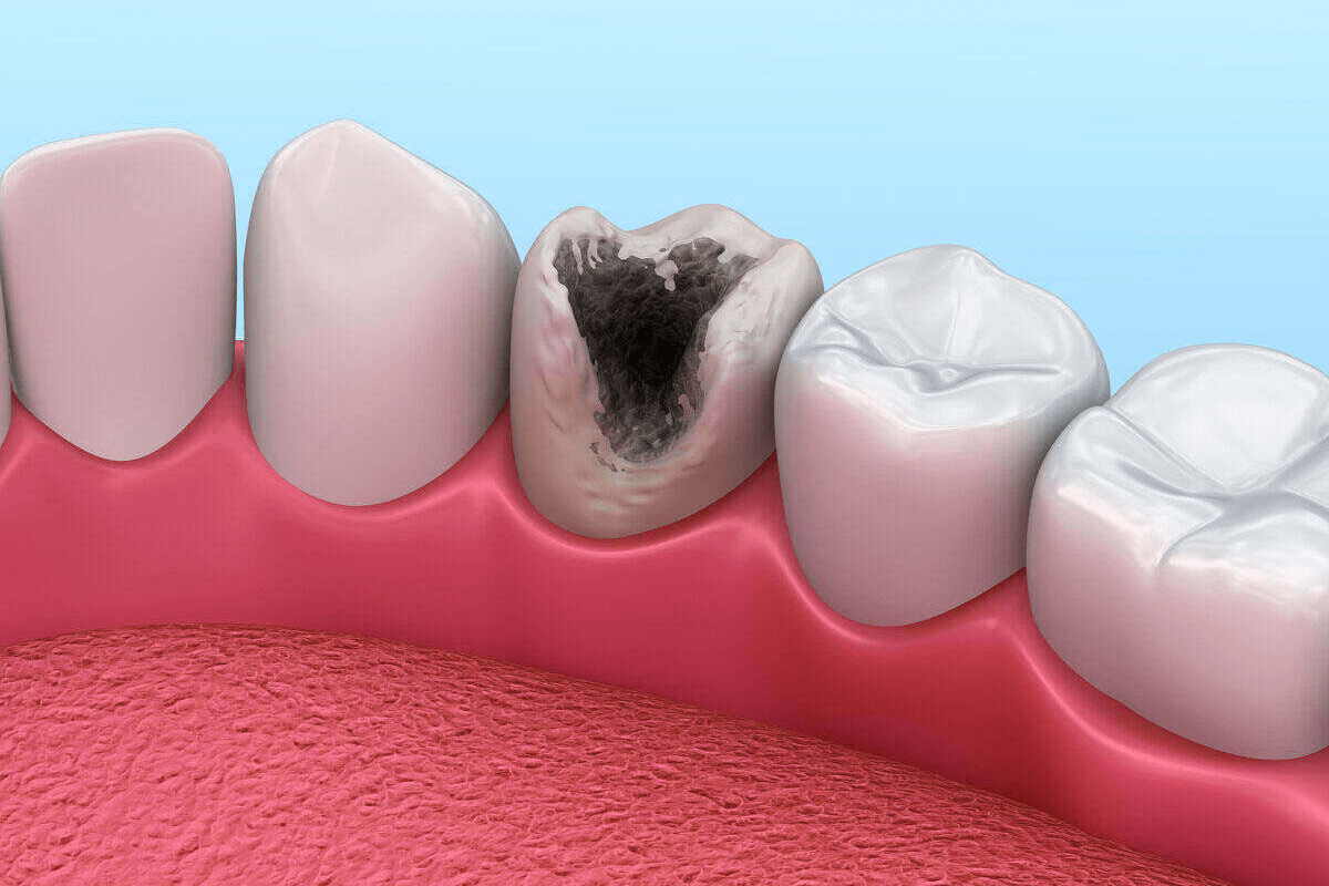 Cavities & Tooth Decay