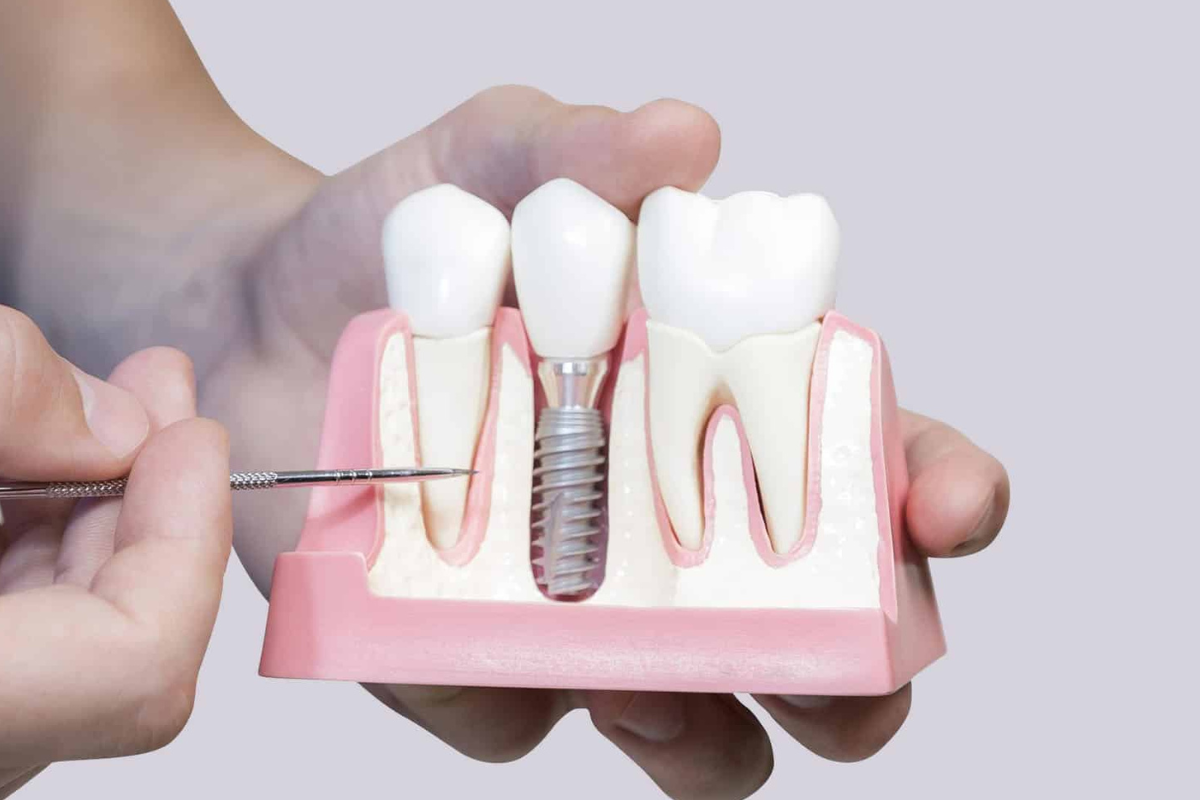 Dental Implants