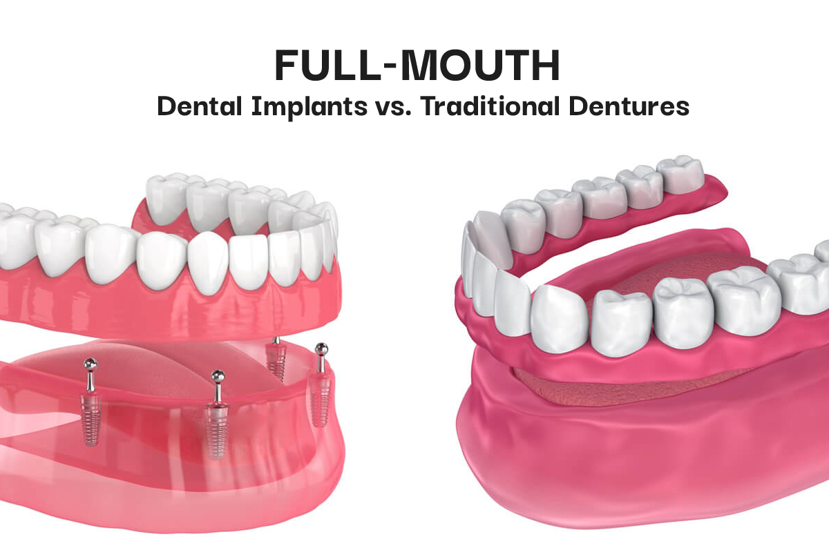 Dental Implants